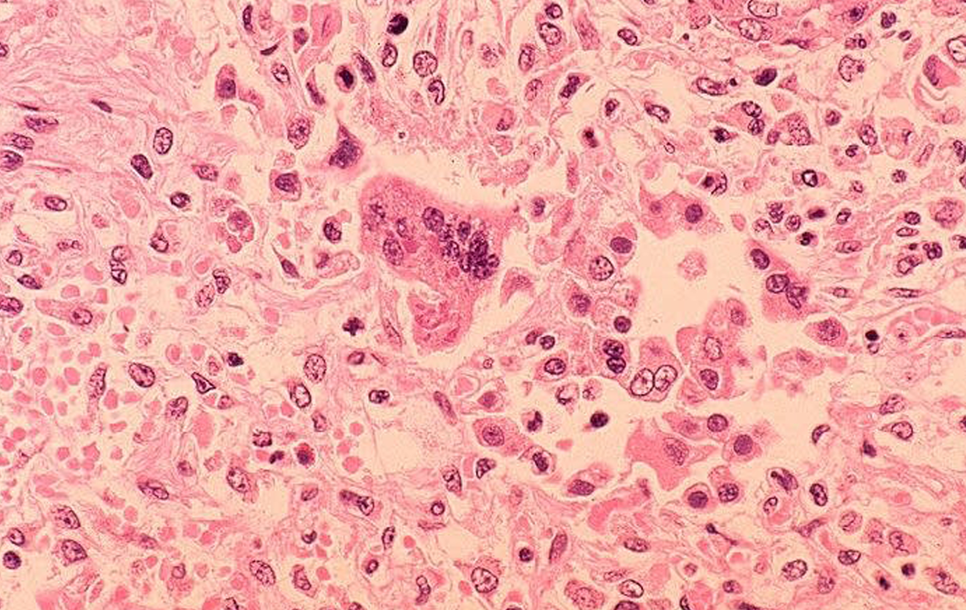 What You Need to Know About Measles