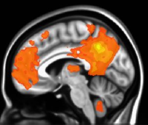 image of an mri brain scan