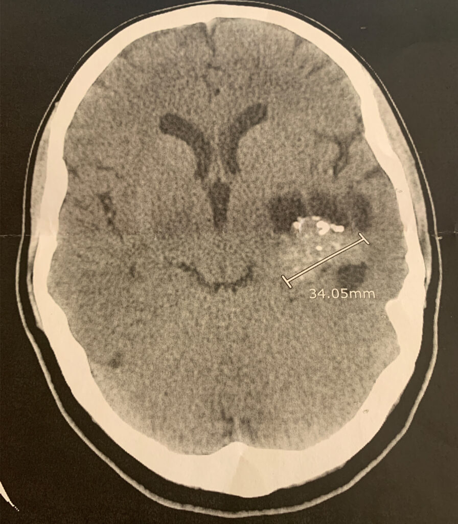 A brain scan showing Megan Butterworth's tumor